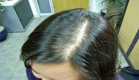 a lady's head who has a hair loss